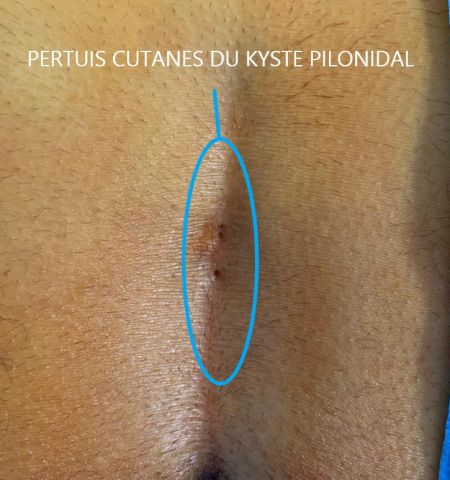 Pilonidal Cyst | Dr. Bruto RANDONE, Digestive Surgeon, Paris, France