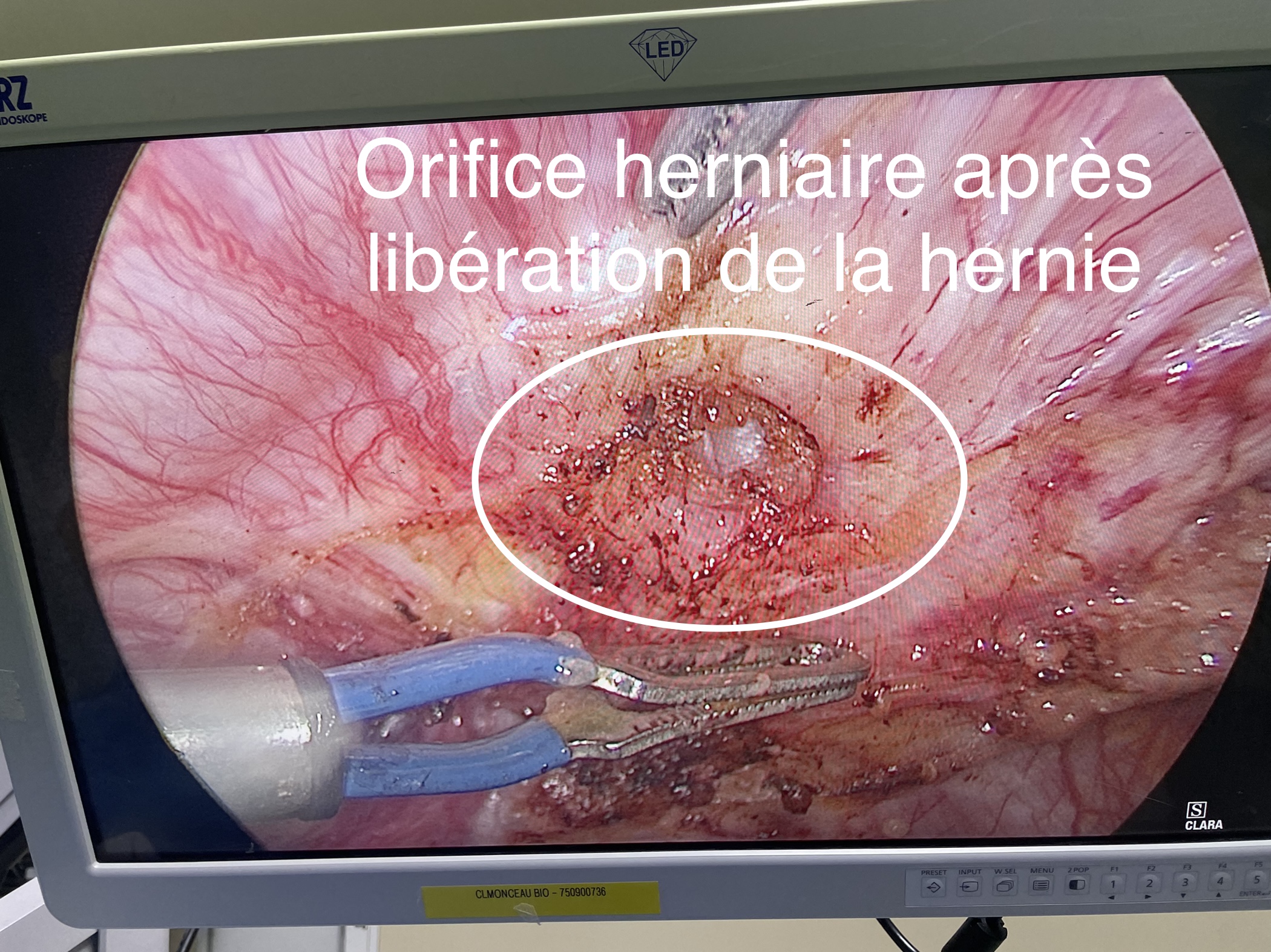 Orifice Herniaire Dr Bruto Randone