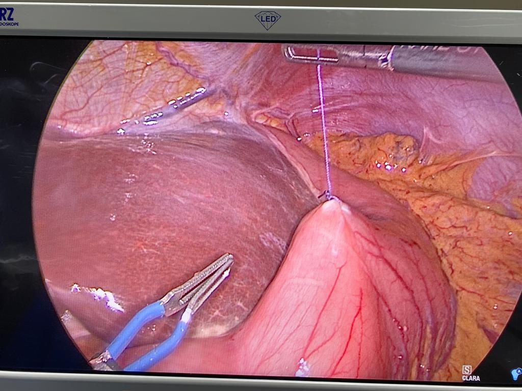 Chirurgie mini invasive estomac tumeur bénigne après localisation  - Dr. Bruto Randone | CHIRURGIE DIGESTIVE PARI