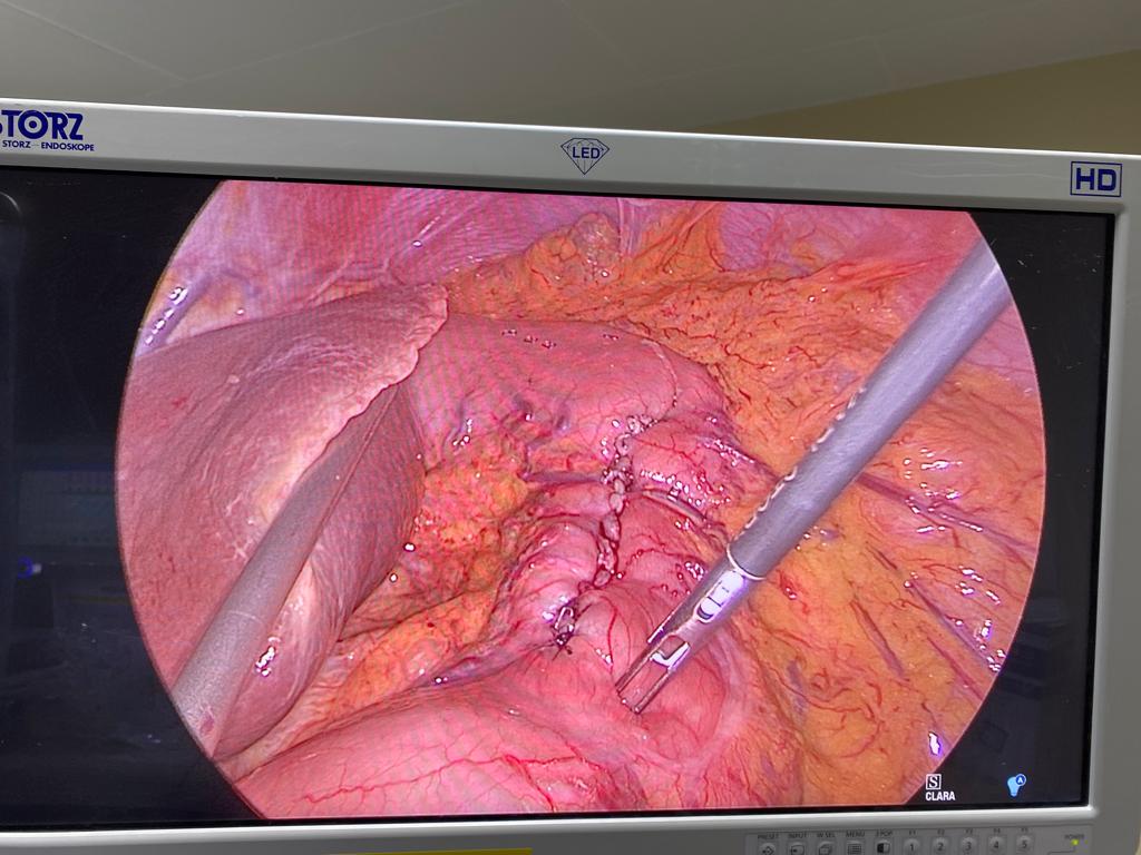 Chirurgie mini invasive estomac tumeur bénigne suture - Dr. Bruto Randone | CHIRURGIE DIGESTIVE PARI