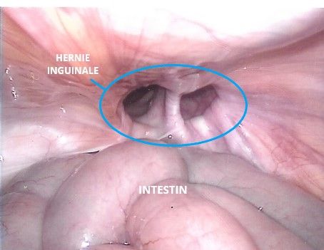 Chirurgie de la Hernie Inguinale