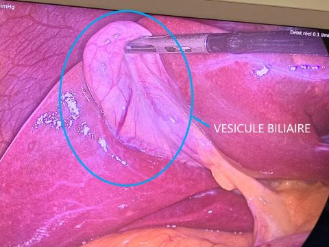 CHIRURGIE DE LA VESICULE BILIAIRE - PARIS | Dr. Bruto RANDONE