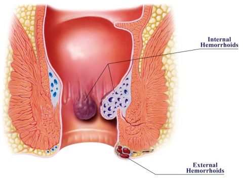 PROCTOLOGIE - HEMORROIDES | Dr. Bruto RANDONE Chirurgien Viscéral et Digestif