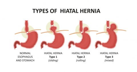 CHIRURGIE DE LA HERNIE HIATALE - Dr. Bruto Randone, Chirurgien Viscéral et Digestif