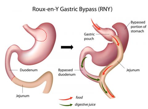 ByPass Gastrique en Y