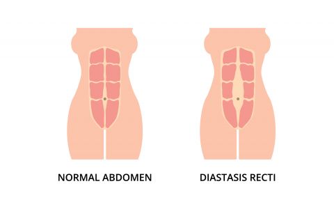 CHIRURGIE DU DIASTASIS - PARIS | FRANCE | CHIRURGIE DIGESTIVE PARIS | Dr. Bruto RANDONE