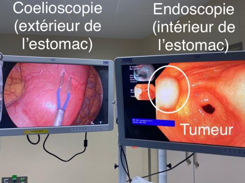 Chirurgie mini invasive estomac tumeur bénigne  - Dr. Bruto Randone | CHIRURGIE DIGESTIVE PARIS